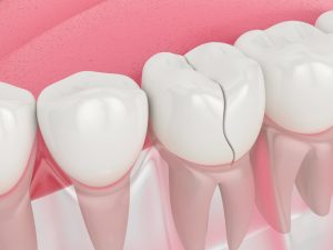 Hvad er en knækket tand?