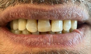 Tandimplantater efter behandling